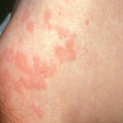 Example of allergies